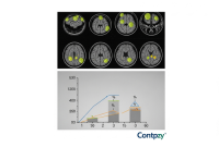 داروی آلزایمر مزایای غافلگیرکننده‌ای رو برای بعضی از بچه‌های مبتلا به اوتیسم نشون میده